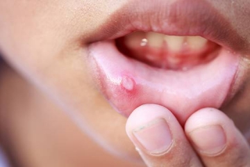 Oral Ulcers in Toddlers and Young Children