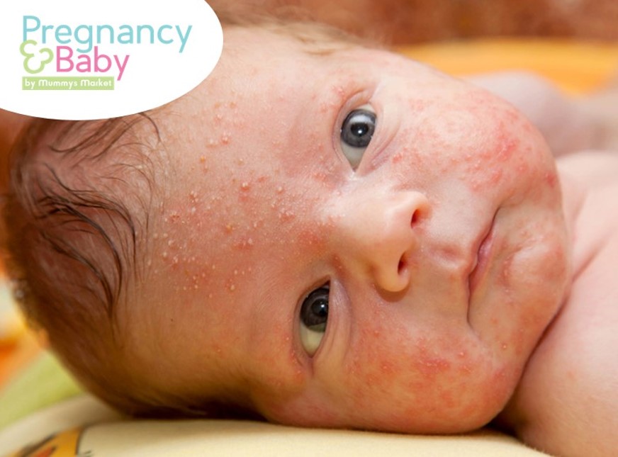 Baby Acne Causes Treatments And Prevention